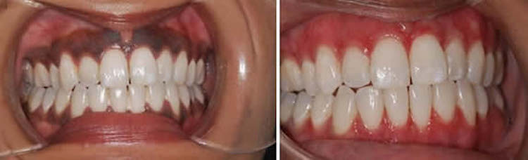 Gums’ Depigmentation